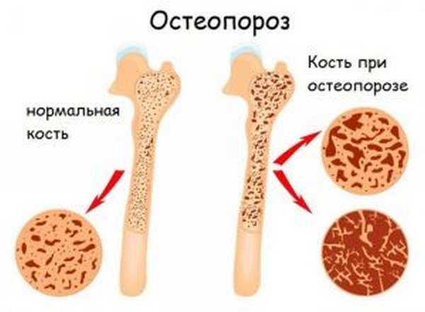 Остеогенон и артроз
